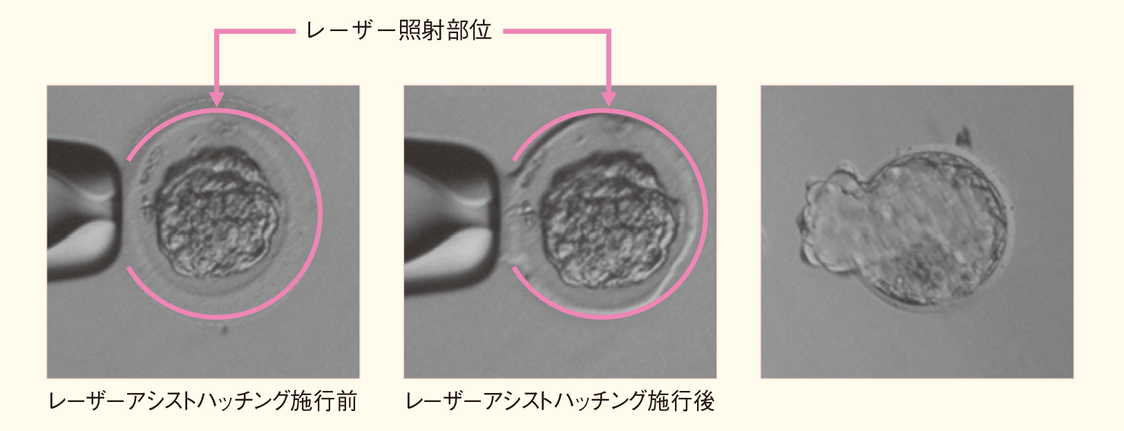 アシ ステッド ハッチング