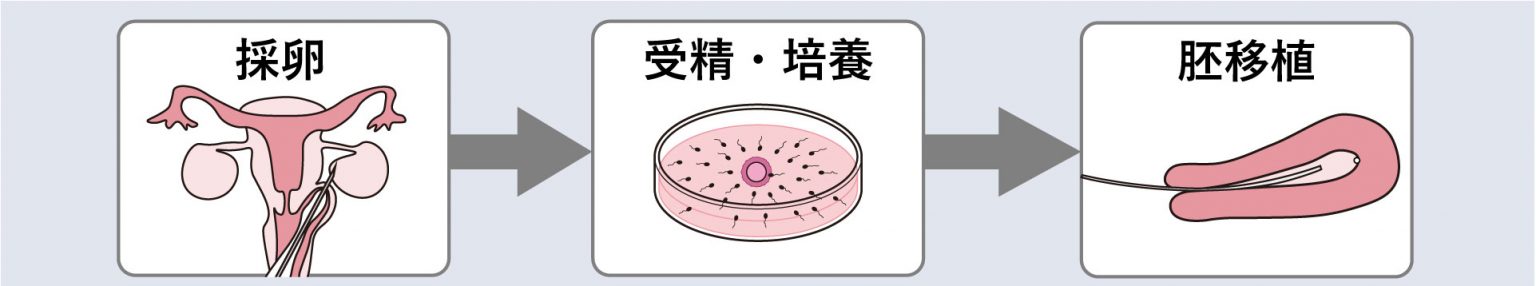 体外受精の流れを図で説明:採卵・受精・胚移植