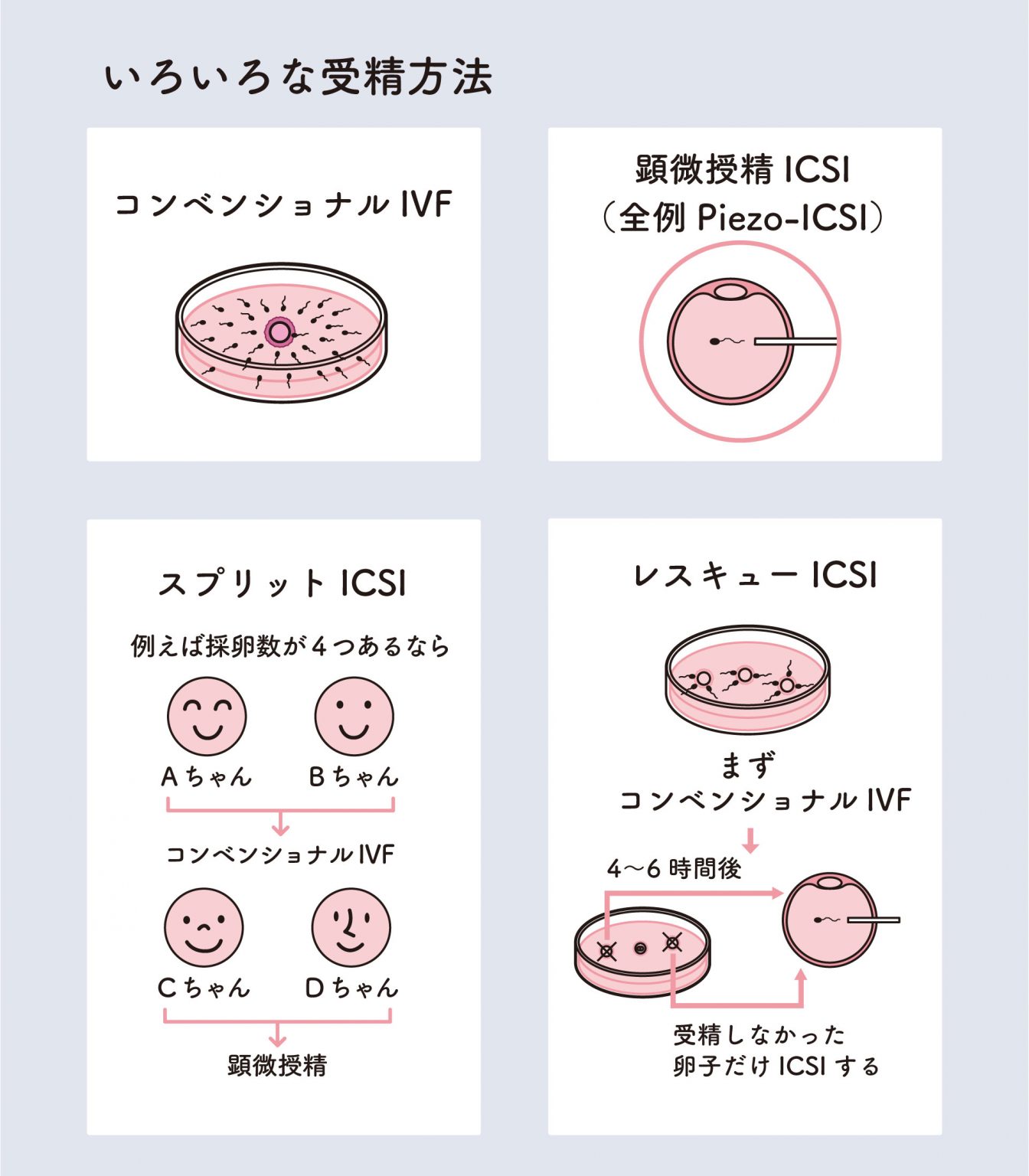 体外受精における4種類の受精方法を図解