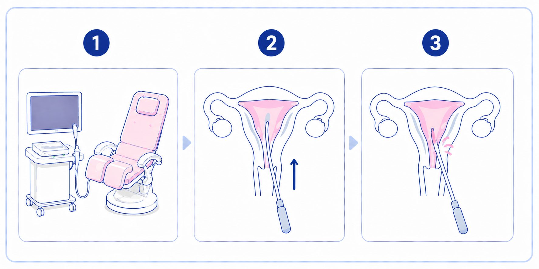 子宮内膜スクラッチの手順