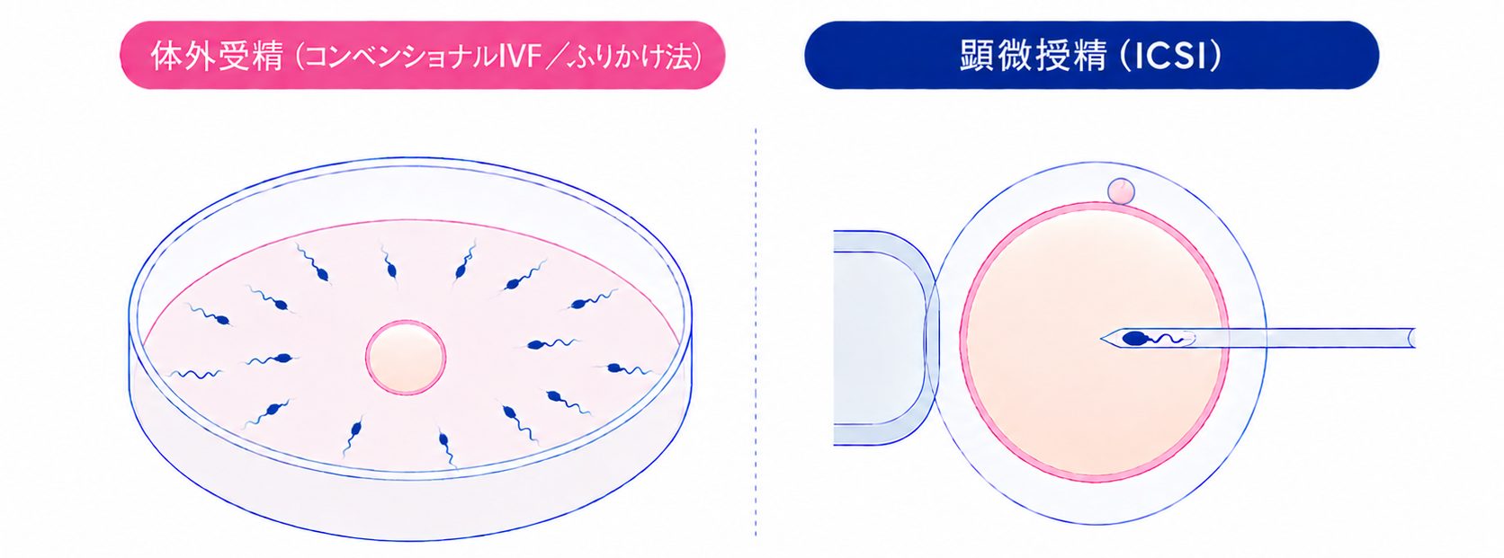 体外受精と顕微授精