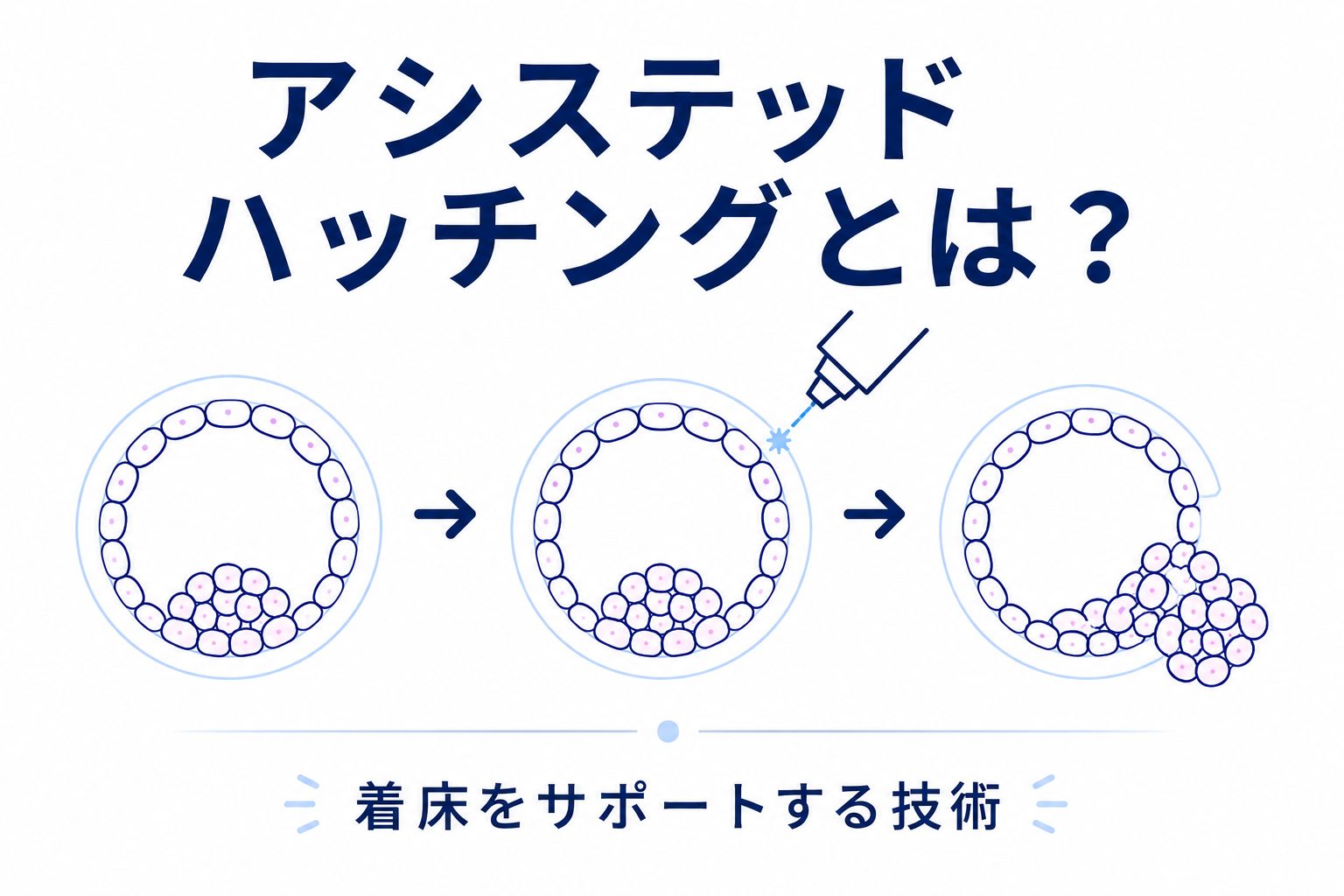 アシ ステッド ハッチング
